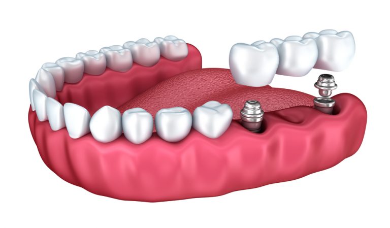 implant supported dental bridge