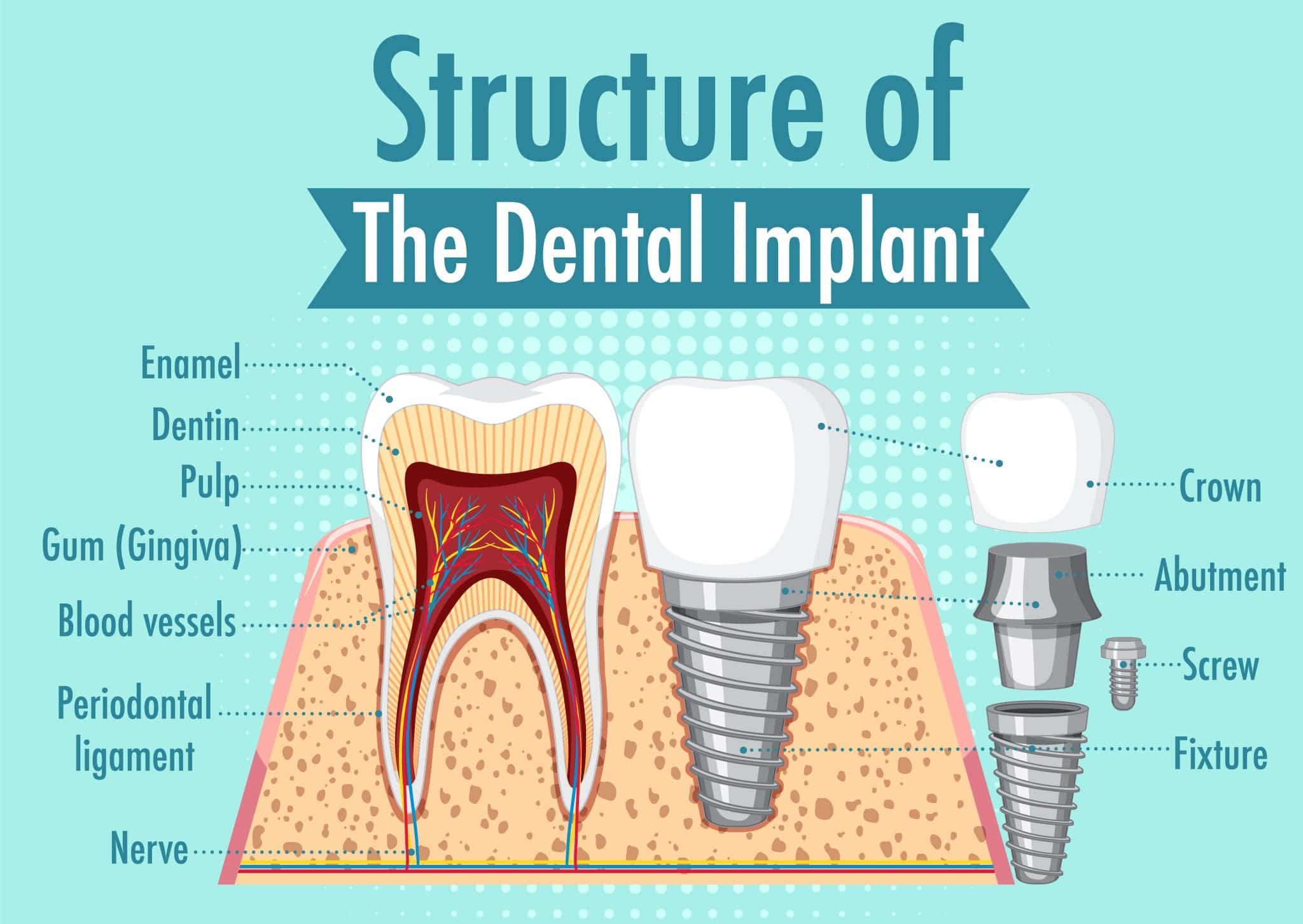 Illustration showing the crown, abutment, screw, and implant body beside a natural tooth