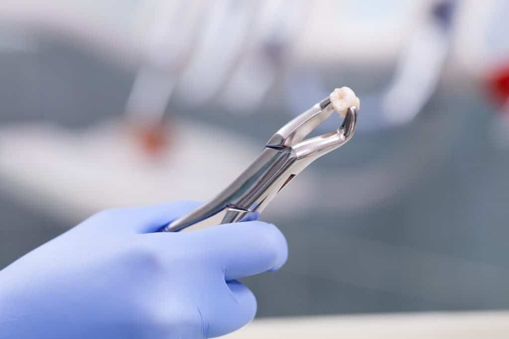 Tooth Extraction Veranda Family Dentistry