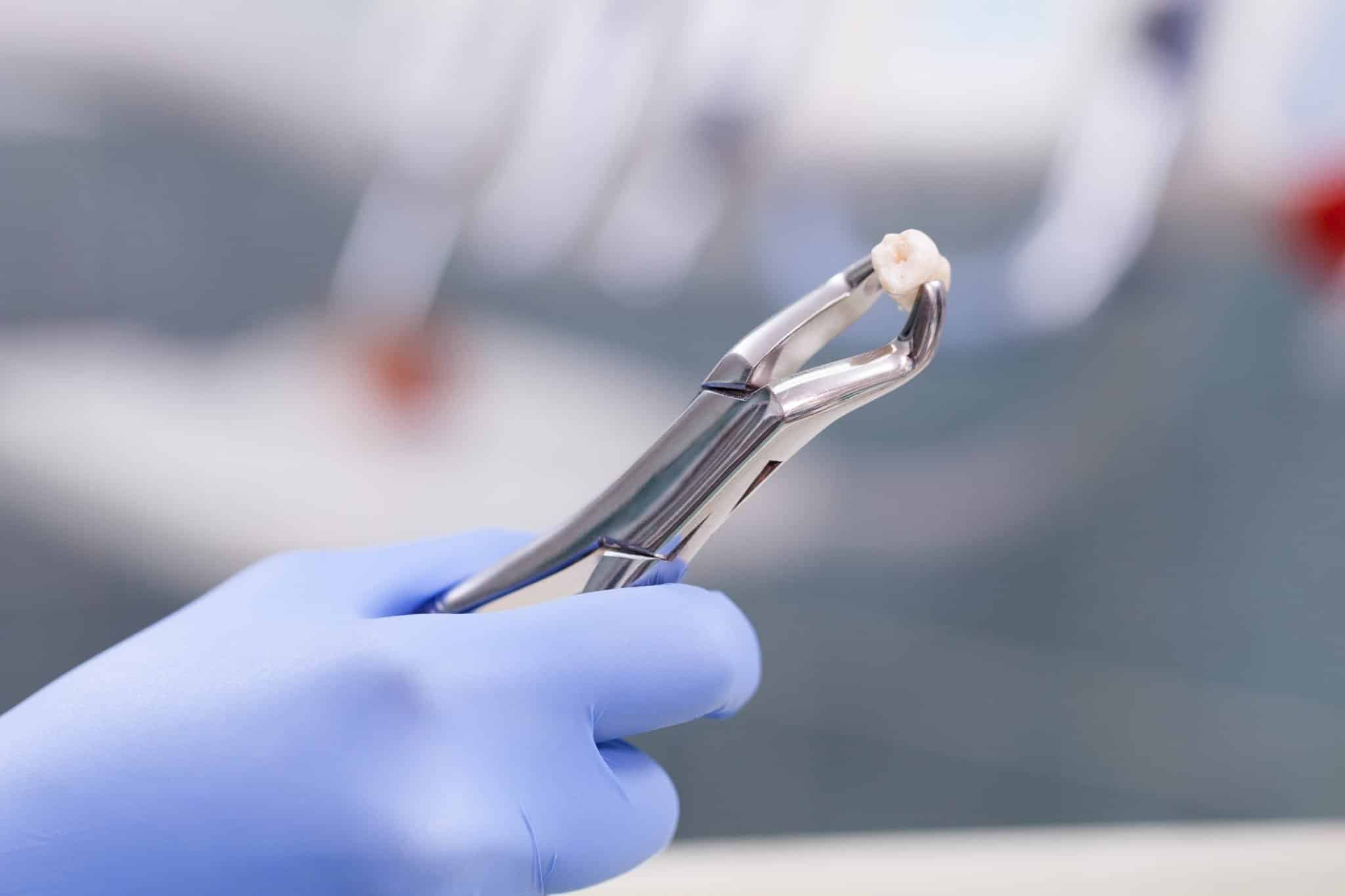 Gloved hand holding an extracted tooth with dental forceps