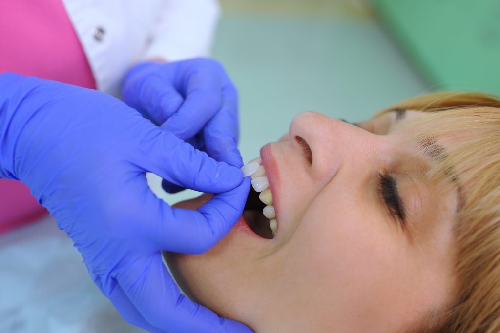 Dental Veneers Port St Lucie Closeup