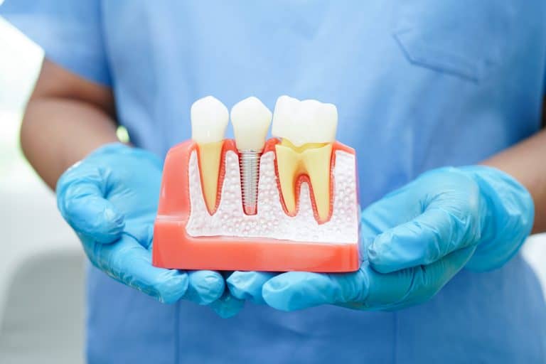 Dental Implants - Veranda Family Dentistry