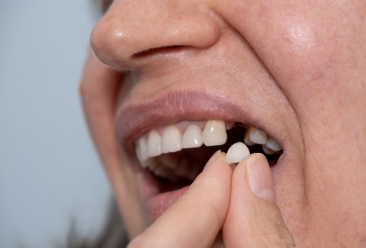 What To Do When A Tooth Falls Out
